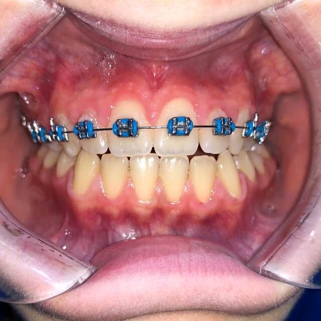 aparat dentar